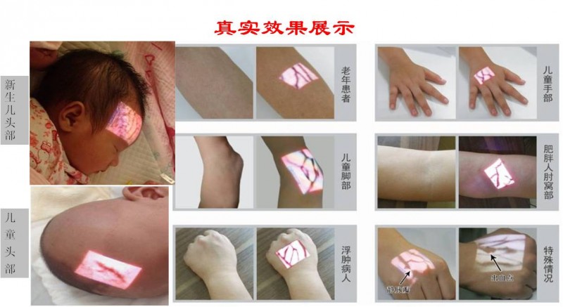 靜脈顯影儀 靜脈顯像儀 血管顯像儀 血管成像儀