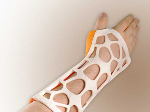 骨科新技術(shù)——3D打印手術(shù)夾板、支具