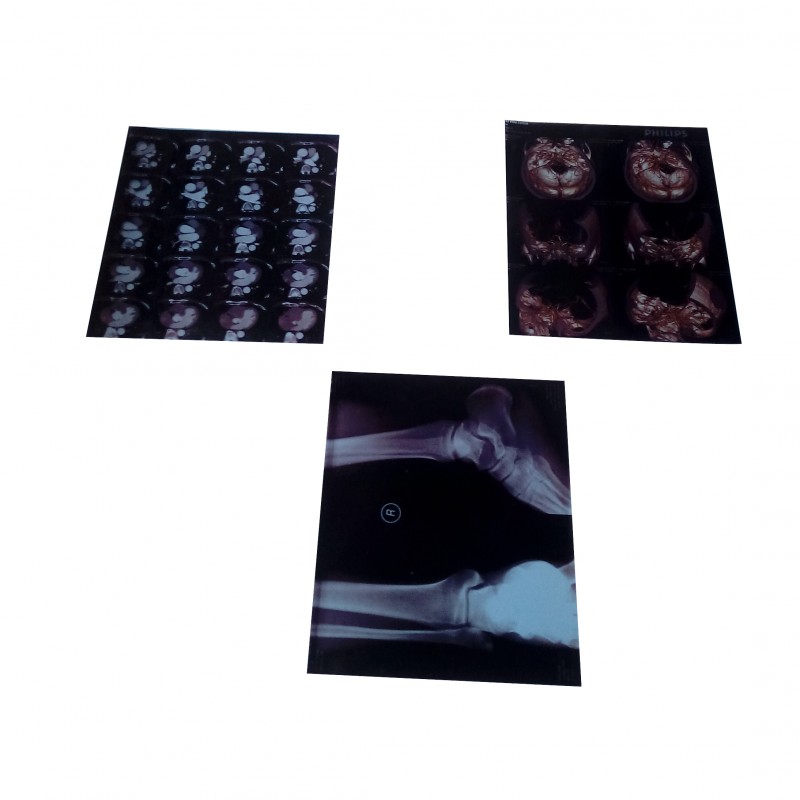 醫(yī)用藍(lán)光膠片