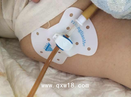 亦康聯(lián)合醫(yī)用導(dǎo)管固定敷料