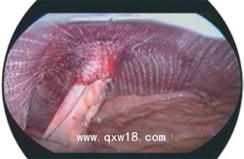 德國PVDF材質(zhì)疝氣補片-IPST