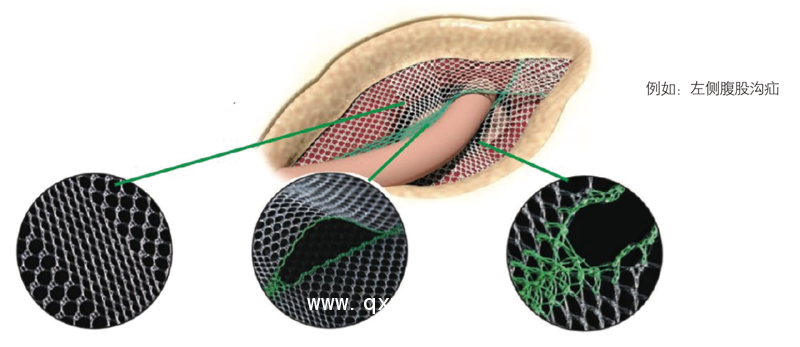 德國PVDF材質(zhì)疝氣補(bǔ)片-Lichtenstein