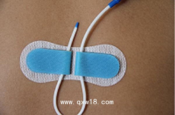 一次性導(dǎo)管固定裝置（留置針延長(zhǎng)管、硬膜外固定裝置）