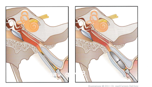 德國(guó)球囊擴(kuò)張導(dǎo)管