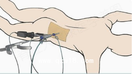 德國椎間孔鏡手術(shù)系統(tǒng)