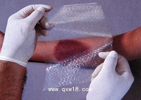 美國(guó)進(jìn)口歐密得Omiderm人工皮膜 傷口敷料