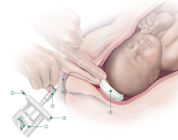 美國進(jìn)口KIWI胎頭真空吸引器