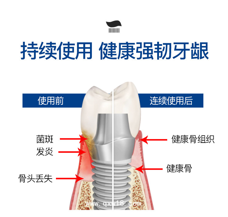 國內(nèi)首支鈦舒鎂種植牙專用護(hù)理牙膏