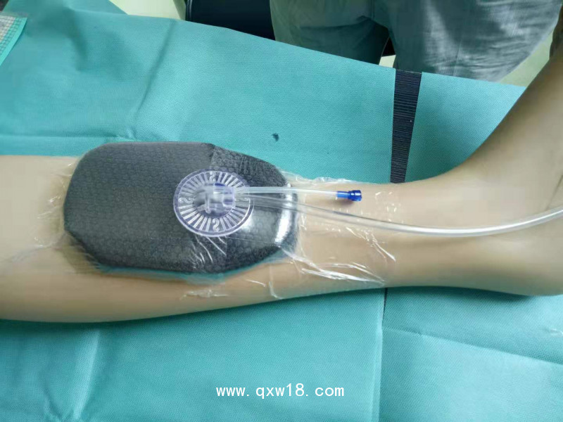 一次性負(fù)壓引流護(hù)創(chuàng)材料 獨(dú)立吸盤(pán)式