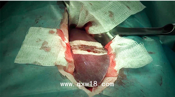 可吸收止血紗布