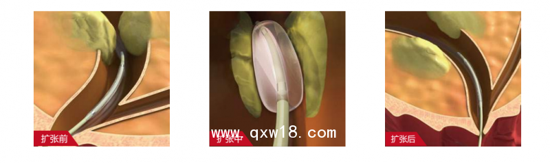 廠家供應(yīng)輸尿管擴(kuò)張球囊導(dǎo)管