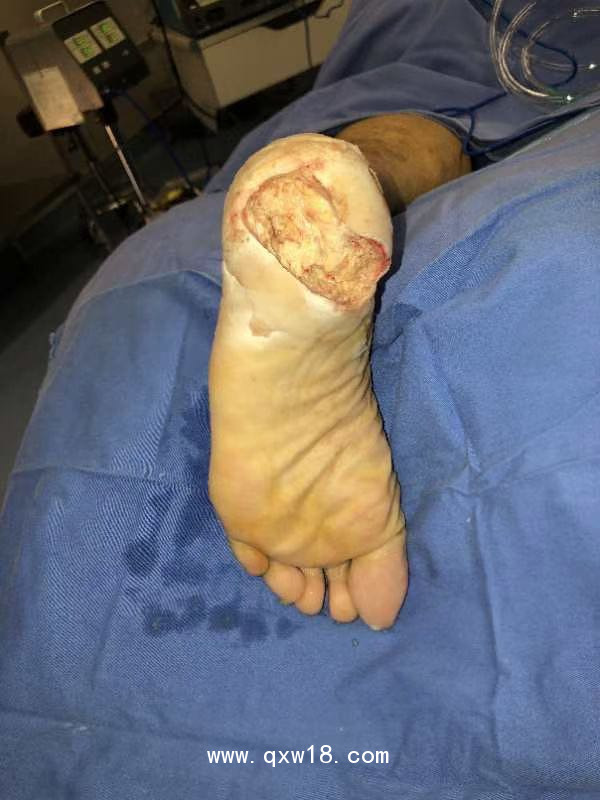 醫(yī)用皮膚減張閉合器