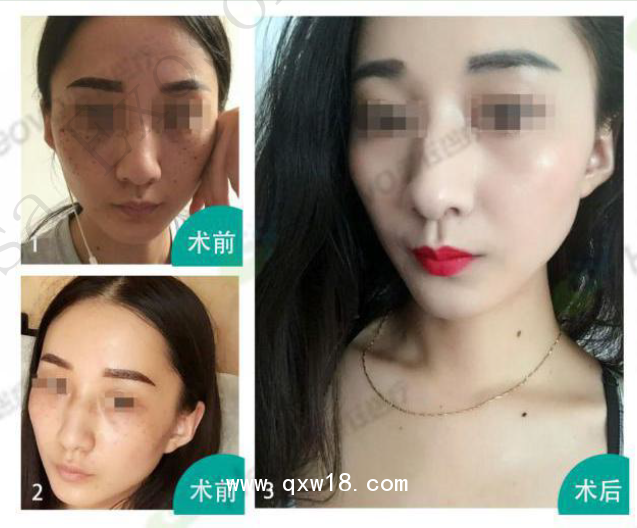 美拉美尚干細胞外泌體液體敷料