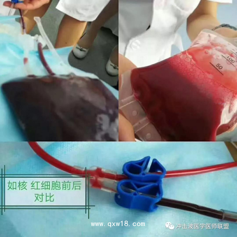 臭氧自體血血袋、三氧自體血血袋、一次性血袋