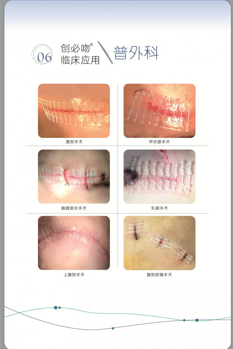 無創(chuàng)皮膚吻合器縫合器