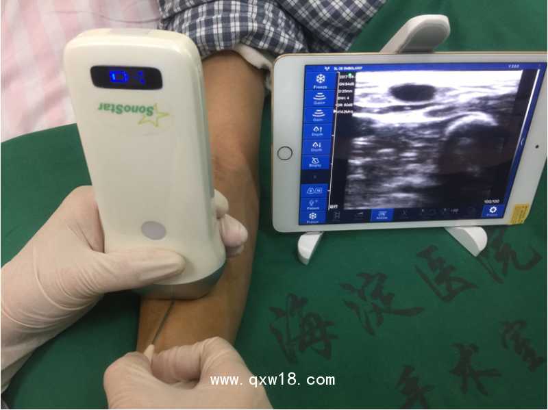 PICC等介入專用無線迷你探頭式超聲