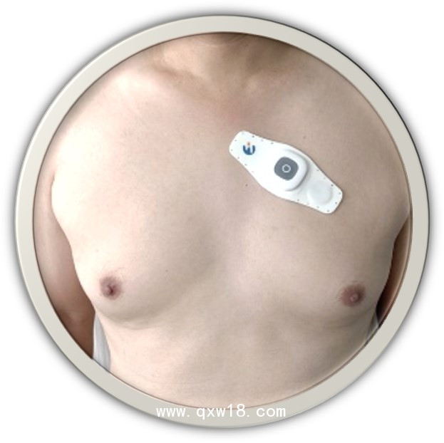 長時貼片式動態(tài)心電記錄儀 專用心電電極 穿戴式心電傳感器