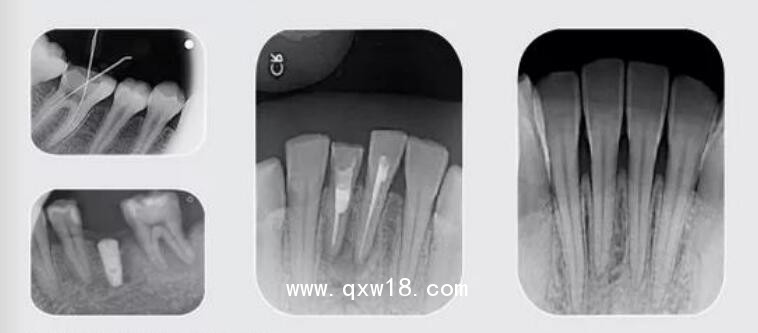 數(shù)字口內(nèi)影像板掃描處理系統(tǒng) TR-120