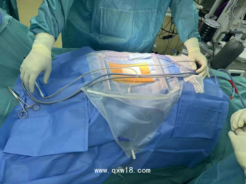 山東奧蘇本骨科脊柱科專用耗材一次性無菌攔水壩手術貼膜套袋