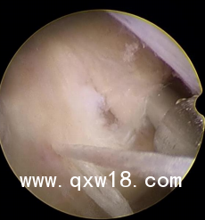 骨科耗材一次性纖維環(huán)縫合器