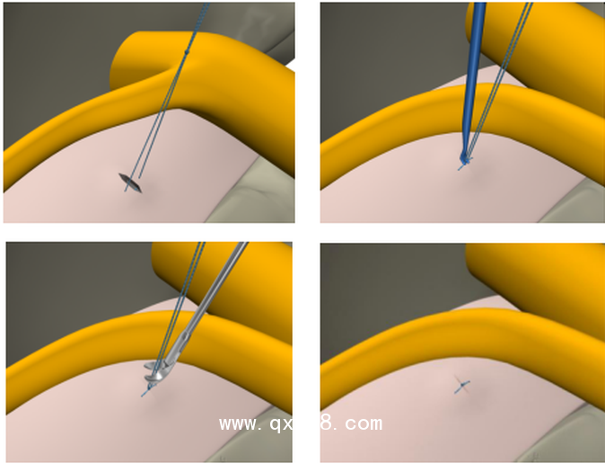 一次性纖維環(huán)縫合器技術(shù)