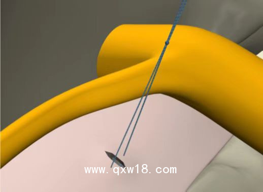 國(guó)產(chǎn)骨科非帶量高值耗材一次性纖維環(huán)縫合器