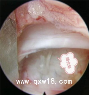 國(guó)產(chǎn)骨科高值耗材非帶量一次性纖維環(huán)縫合器