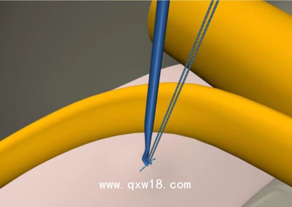 纖維環(huán)縫合器