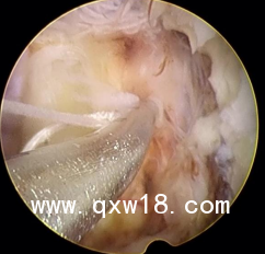 一次性纖維環(huán)縫合器骨科非帶量耗材