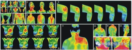 醫(yī)用紅外熱CT