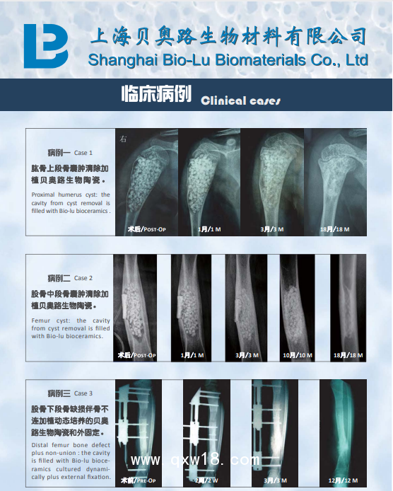 國產(chǎn)貝奧路多孔生物陶瓷 骨科 骨缺損 脊柱融合 骨腫瘤 骨不連 關節(jié)融合