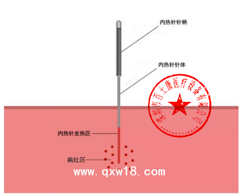 內(nèi)熱式針灸治療儀  甘肅青海寧夏地區(qū)招商