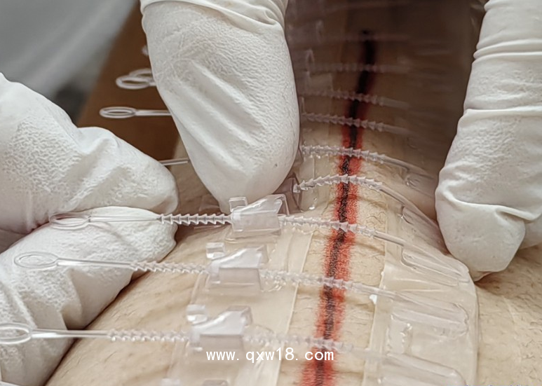 一次性皮膚縫合器/醫(yī)用無針縫合器/醫(yī)用免縫拉鏈/一次性皮膚吻合器/一次性皮膚減張器