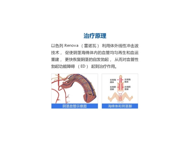體外線性沖擊波治療儀