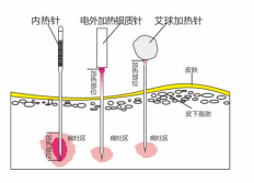 內(nèi)熱針針具、銀質(zhì)針設(shè)備 內(nèi)熱針治療儀