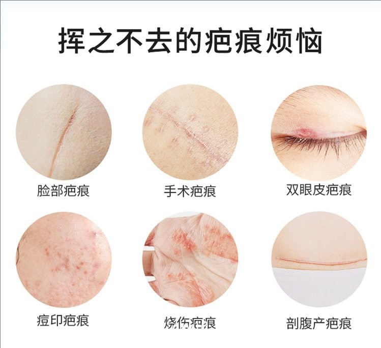 疤痕凝膠/二類械字號醫(yī)用祛疤凝膠/廠里批發(fā)可代加工疤痕凝膠