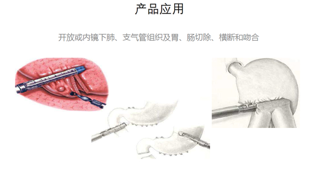 吻合器產(chǎn)品應(yīng)用