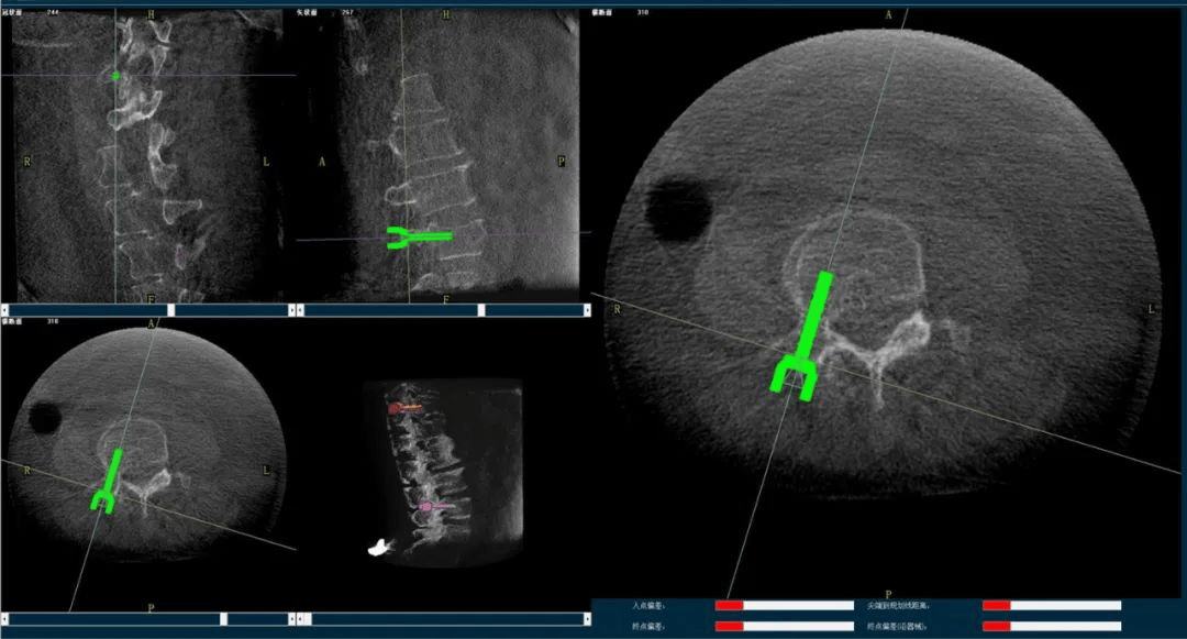 骨科手術(shù)機器人規(guī)劃圖像